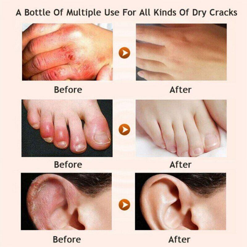 Crema Para Los Pies Manos Puedes Remover La Resequedad Y Las Grietas Rapidamente