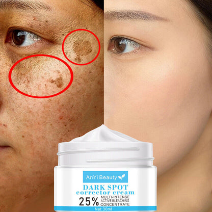 Strong Removal Melasma Whitening Cream Freckle Speckle Sunburn Spots Pigment