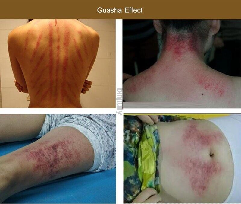 Electric Heating Moxibustion Massager Hot Compress Beauty Spa Guasha Moxa Steam