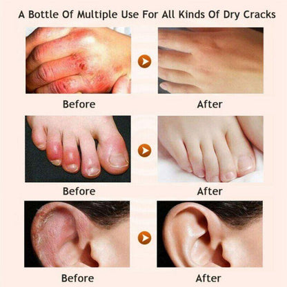 Crema Para Los Pies Manos Puedes Remover La Resequedad Y Las Grietas Rapidamente