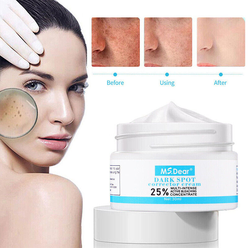 Strong Removal Melasma Whitening Cream Freckle Speckle Sunburn Spots Pigment