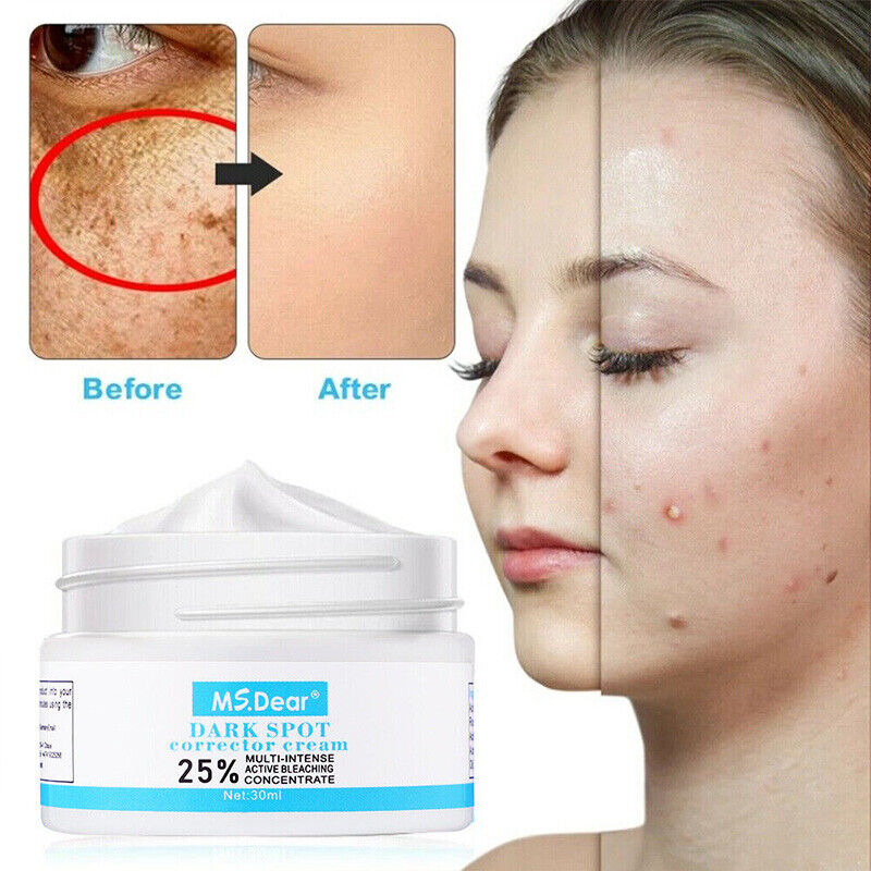 Strong Removal Melasma Whitening Cream Freckle Speckle Sunburn Spots Pigment