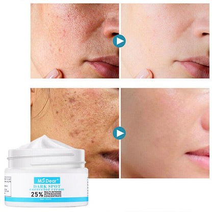 Strong Removal Melasma Whitening Cream Freckle Speckle Sunburn Spots Pigment
